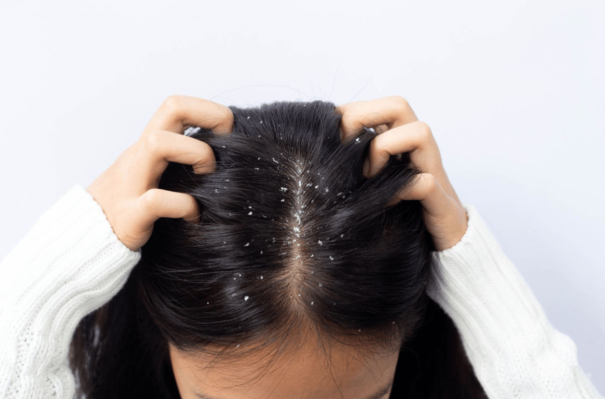 Understanding Dandruff: Causes, Treatments, and Management Tips - Katharē Hair Care