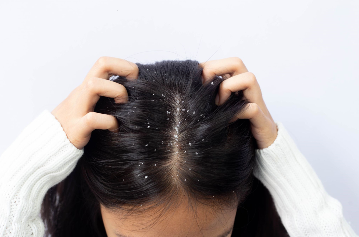 Understanding Dandruff: Causes, Treatments, and Management Tips